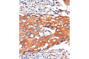 Immunohistochemistry of paraffin-embedded Human breast cancer using IQG Rabbit pAb (ABIN7268022) at dilution of 1:100 (40x lens). (IQGAP2 Antikörper  (AA 1330-1440))