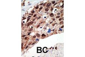 Formalin-fixed and paraffin-embedded human cancer tissue reacted with the SETD7 polyclonal antibody  , which was peroxidase-conjugated to the secondary antibody, followed by DAB staining. (SETD7 Antikörper  (Internal Region))