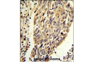 PKM2 (N-term ) Antibody (ABIN653018 and ABIN2842641) IHC analysis in formalin fixed and paraffin embedded human lung carcinoma followed by peroxidase conjugation of the secondary antibody and DAB staining. (PKM2 Antikörper  (N-Term))