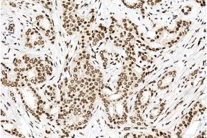 Immunohistochemical analysis of paraffin-embedded human breast cancer tissue using (ABIN1881702 and ABIN2838736). (PTBP1 Antikörper  (N-Term))