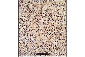 Formalin-fixed and paraffin-embedded human lymphoma reacted with LCK Antibody (C-term), which was peroxidase-conjugated to the secondary antibody, followed by DAB staining. (LCK Antikörper  (C-Term))