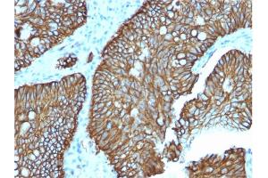 Formalin-fixed, paraffin-embedded human Colon stained with Cadherin 17 / CDH17 Mouse Monoclonal Antibody (CDH17/2618). (LI Cadherin Antikörper  (AA 242-418))