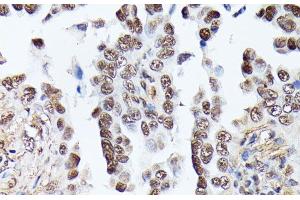 Immunohistochemistry of paraffin-embedded Human lung cancer using TPI1 Polyclonal Antibody at dilution of 1:100 (40x lens). (TPI1 Antikörper)