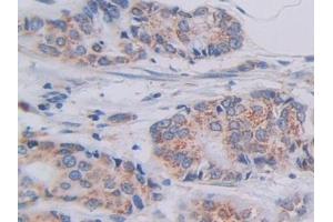 Detection of SHMT2 in Human Breast cancer Tissue using Polyclonal Antibody to Serine Hydroxymethyltransferase 2, Mitochondrial (SHMT2) (SHMT2 Antikörper  (AA 30-504))