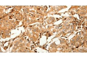 Immunohistochemistry of paraffin-embedded Human lung cancer tissue using SFRP1 Polyclonal Antibody at dilution 1:80 (SFRP1 Antikörper)