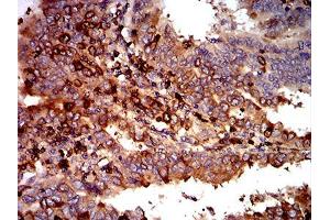 Immunohistochemical analysis of paraffin-embedded endometrial cancer tissues using C3C mouse mAb with DAB staining. (Complement C3c Antikörper  (AA 1521-1649))