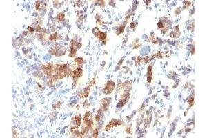 Formalin-fixed, paraffin-embedded human gastric carcinoma stained with MUC5 antibody (MUC5AC/917). (MUC5AC Antikörper)