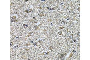 Immunohistochemistry of paraffin-embedded Human brain cancer using WIPI1 Polyclonal Antibody at dilution of 1:100 (40x lens). (WIPI1 Antikörper)
