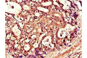 Immunohistochemistry of paraffin-embedded human gastric cancer using ABIN7173790 at dilution of 1:100 (RANKL Antikörper  (AA 73-306))