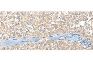 Immunohistochemistry of paraffin-embedded Human ovarian cancer tissue using SNX6 Polyclonal Antibody at dilution of 1:40(x200)