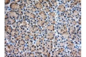 Immunohistochemical staining of paraffin-embedded Adenocarcinoma of Human ovary tissue using anti-PDE4A mouse monoclonal antibody. (PDE4A Antikörper)
