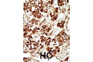 Formalin-fixed and paraffin-embedded human cancer tissue reacted with the primary antibody, which was peroxidase-conjugated to the secondary antibody, followed by AEC staining. (ZAK Antikörper  (AA 271-300))