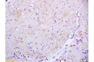 Formalin-fixed and paraffin embedded human gastric carcinoma labeled with Anti ROCK2 Polyclonal Antibody, Unconjugated (ABIN673359) at 1:200 followed by conjugation to the secondary antibody and DAB staining (ROCK2 Antikörper  (AA 1001-1300))