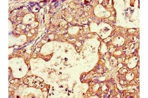 Immunohistochemistry of paraffin-embedded human gastric cancer using ABIN7144511 at dilution of 1:100 (AQP3 Antikörper  (AA 210-244))