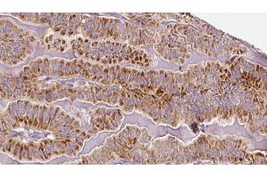 ABIN6273336 at 1/100 staining Human thyroid cancer tissue by IHC-P. (TSH receptor Antikörper  (Internal Region))