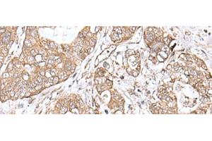 Immunohistochemistry of paraffin-embedded Human gastric cancer tissue using TEAD2 Polyclonal Antibody at dilution of 1:60(x200) (TEAD2 Antikörper)