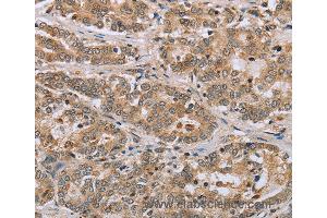 Immunohistochemistry of Human liver cancer using CLEC16A Polyclonal Antibody at dilution of 1:45 (CLEC16A Antikörper)