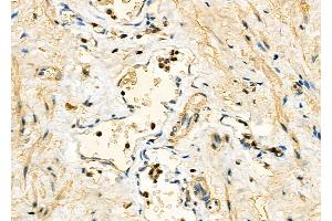 ABIN6260570 and ABIN6277791 at 1/100 staining Human ovarian cancer by IHC-P.