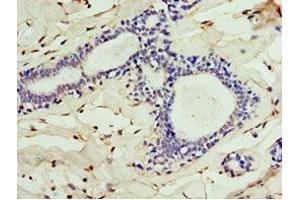Immunohistochemistry of paraffin-embedded human breast cancer using ABIN7147563 at dilution of 1:100 (ALG1 Antikörper  (AA 215-464))