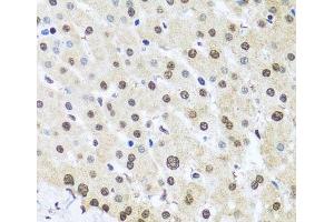 Immunohistochemistry of paraffin-embedded Human liver damage using FUBP1 Polyclonal Antibody at dilution of 1:100 (40x lens). (FUBP1 Antikörper)