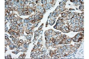 Immunohistochemical staining of paraffin-embedded Adenocarcinoma of Human breast tissue using anti-IGF2BP2 mouse monoclonal antibody. (IGF2BP2 Antikörper)