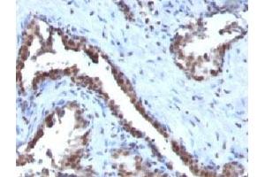 Formalin-fixed, paraffin-embedded human prostate carcinoma stained with Cyclin B1 antibody. (Cyclin B1 Antikörper)