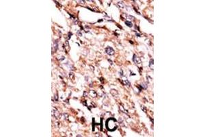 Formalin-fixed and paraffin-embedded human cancer tissue reacted with the primary antibody, which was peroxidase-conjugated to the secondary antibody, followed by AEC staining. (BCKDK Antikörper  (AA 120-151))