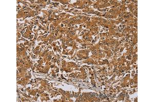 Immunohistochemistry of Human lung cancer using RAB8A Polyclonal Antibody at dilution of 1:45 (RAB8A Antikörper)