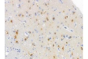 ABIN6254999 and ABIN6267500 at 1/100 staining human glioblastoma by IHC-P. (BRCA1 Antikörper  (pSer1524))
