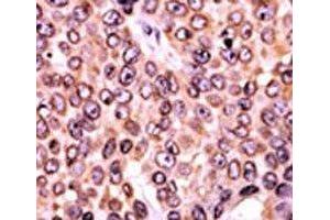 IHC analysis of FFPE human breast carcinoma tissue stained with the p-p21 antibody. (p21 Antikörper  (pThr145))