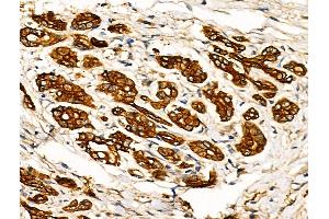ABIN6257226 and ABIN6274237 at 1/100 staining Human pancreatic cancer by IHC-P. (GRK5 Antikörper  (Internal Region))