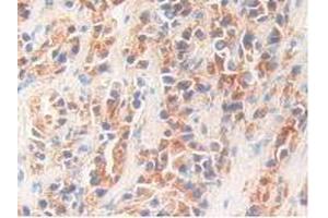 IHC-P analysis of Human Prostate Gland Cancer Tissue, with DAB staining. (Kallikrein 11 Antikörper  (AA 39-282))