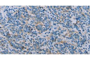Immunohistochemistry of paraffin-embedded Human breast cancer using Claudin 4 Polyclonal Antibody at dilution of 1:35