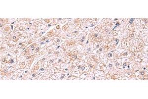 Immunohistochemistry of paraffin-embedded Human liver cancer tissue using PDRG1 Polyclonal Antibody at dilution of 1:75(x200) (PDRG1 Antikörper)