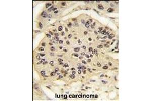 Formalin-fixed and paraffin-embedded human lung carcinoma tissue reacted with SOX2 Antibody (ABIN387798 and ABIN2843854) , which was peroxidase-conjugated to the secondary antibody, followed by DAB staining. (SOX2 Antikörper)