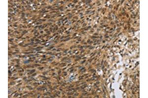 The image on the left is immunohistochemistry of paraffin-embedded Human cervical cancer tissue using ABIN7190675(FOXB1 Antibody) at dilution 1/30, on the right is treated with synthetic peptide.