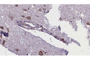 ABIN6276388 at 1/100 staining Human brain cancer tissue by IHC-P. (ACVR1C/ALK7 Antikörper  (C-Term))