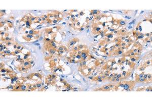 Immunohistochemistry of paraffin-embedded Human thyroid cancer tissue using APOL6 Polyclonal Antibody at dilution 1:50