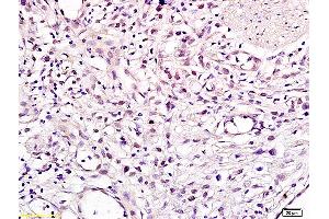 Formalin-fixed and paraffin embedded human gastric carcinoma labeled with Anti CHMP1A Polyclonal Antibody, Unconjugated (ABIN705236) at 1:200 followed by conjugation to the secondary antibody and DAB staining (CHMP1A Antikörper  (AA 51-150))