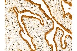 ABIN7094791 and ABIN7098842 at 1/100 staining Human kidney cancer by IHC-P. (UBA1 Antikörper  (Internal Region))