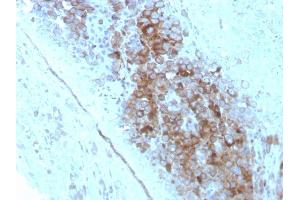 Formalin-fixed, paraffin-embedded human Melanoma stained with CD63 Mouse Monoclonal Antibody (LAMP3/2789).