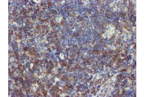 Immunohistochemical staining of paraffin-embedded Human lymphoma tissue using anti-NMT2 mouse monoclonal antibody. (NMT2 Antikörper)
