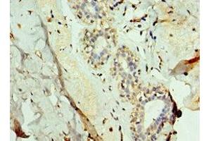 Immunohistochemistry of paraffin-embedded human breast cancer using ABIN7143736 at dilution of 1:100 (FUT6 Antikörper  (AA 170-359))
