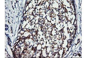 Immunohistochemical staining of paraffin-embedded Adenocarcinoma of Human breast tissue using anti-ERBB2 mouse monoclonal antibody.