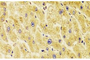 Immunohistochemistry of paraffin-embedded Human liver damage using TXNL1 Polyclonal Antibody at dilution of 1:100 (40x lens). (TXNL1 Antikörper)