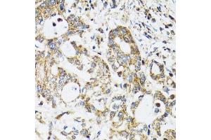 Immunohistochemistry of paraffin-embedded human colon carcinoma using EPB41 antibody (ABIN1872554) at dilution of 1:100 (40x lens). (EPB41 Antikörper)