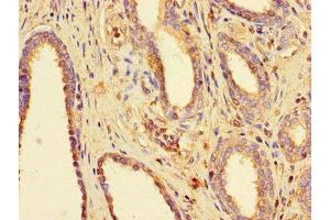 Immunohistochemistry of paraffin-embedded human prostate cancer using ABIN7160076 at dilution of 1:100 (BUB3 Antikörper  (AA 6-217))