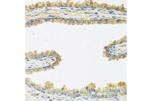 Immunohistochemistry of paraffin-embedded human prostate using CRHBP antibody (ABIN5973945) at dilution of 1/100 (40x lens). (CRHBP Antikörper)