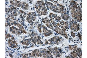 Immunohistochemical staining of paraffin-embedded Carcinoma of liver tissue using anti-AKR1A1mouse monoclonal antibody. (AKR1A1 Antikörper)