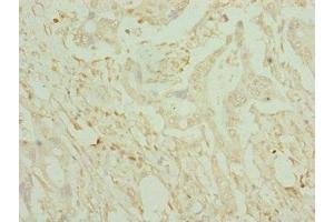 Immunohistochemistry of paraffin-embedded human pancreatic cancer using ABIN7149016 at dilution of 1:100